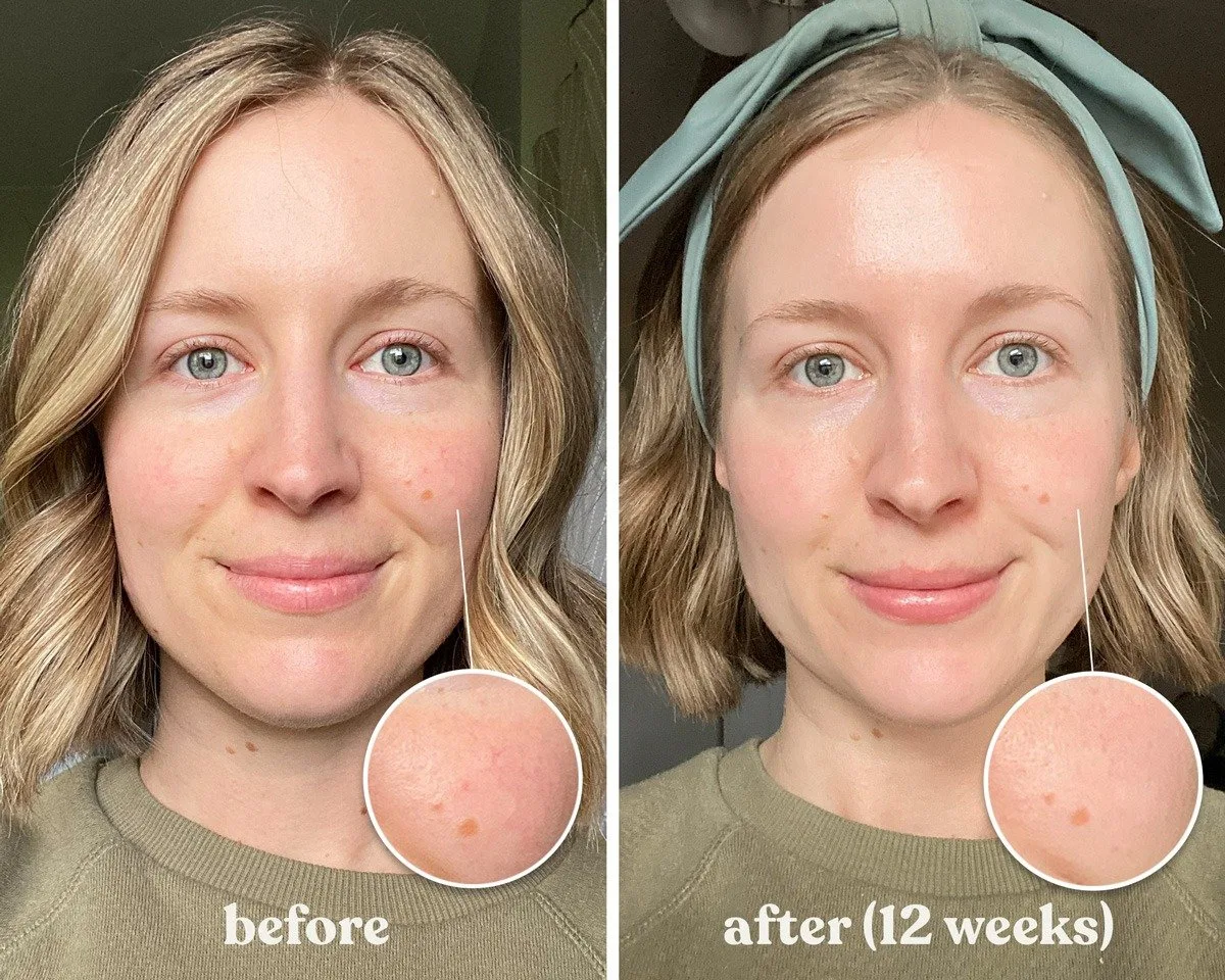 red light therapy bare skin vs clothed treatment
